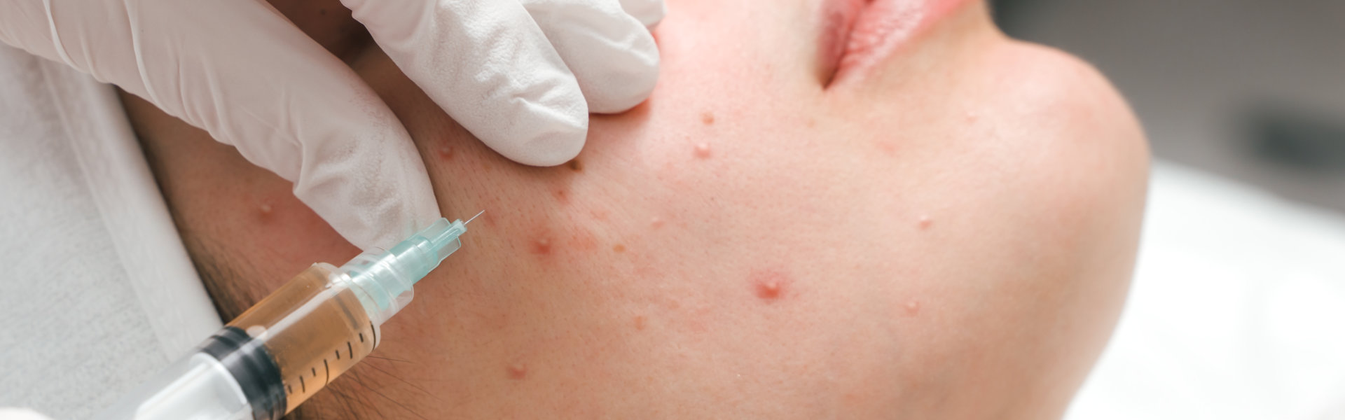 young woman in a cosmetology clinic, undergoing acne treatment with injections